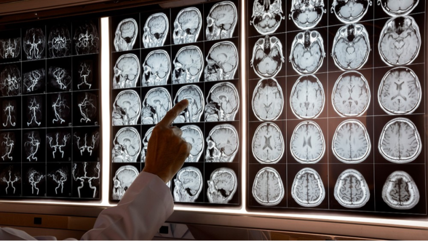 neurological disorders treatment